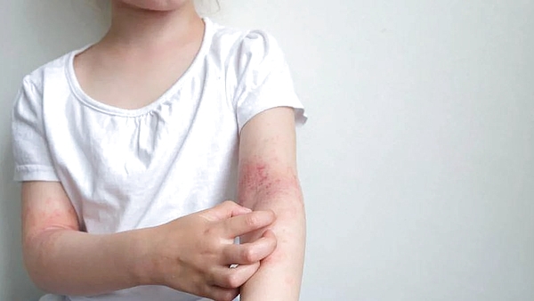 El vapeo en lugares cerrados favorecer la aparición de dermatitis atópica en los niños