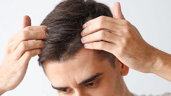 Chau caspa para siempre: el método casero para eliminarla del cabello en solo un día